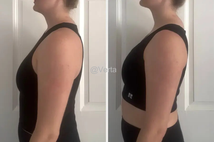 Woman standing with improved posture after 2 weeks